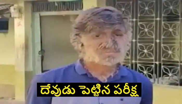 Viral Video : పాపం.. బాలుడి ముఖం నిండా వెంట్రుకలు.. చూసి భయపడుతున్న జనం !!