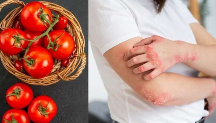 Tomato Side Effects: టొమాటోతో కలిగే నష్టాలు, ఈ తీవ్ర వ్యాధులకు కారణం కావచ్చు