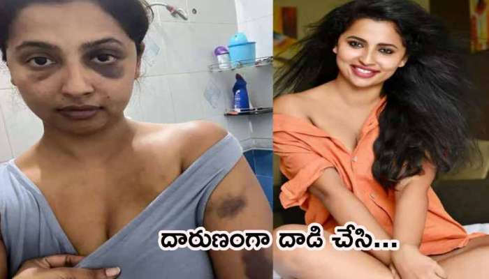 Anicka Vikramman: నటిని చచ్చేలా కొట్టిన ప్రియుడు.. కలకలం రేపుతున్న ఫొటోలు!