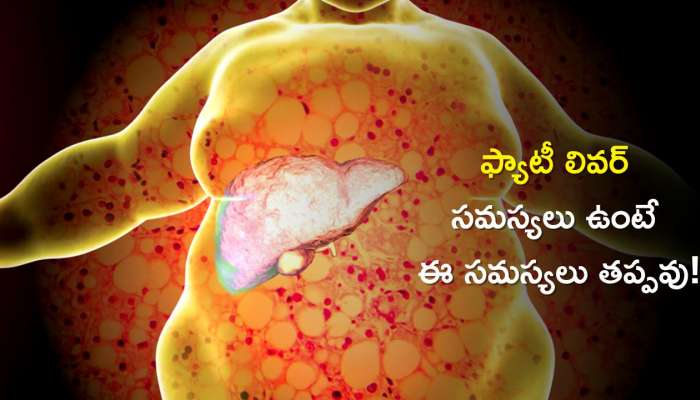 Fatty Liver Causes & Symptoms: ఫ్యాటీ లివర్ ఉన్నవారు ఈ సమస్యలకు కూడా గురికావొచ్చు!