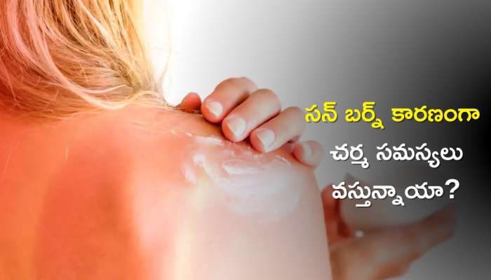 Reduce Sunburn in 2 Days: సన్ బర్న్ సమస్యలను 2 రోజుల్లో తగ్గించే అలోవెరా &amp; రోజ్ వాటర్