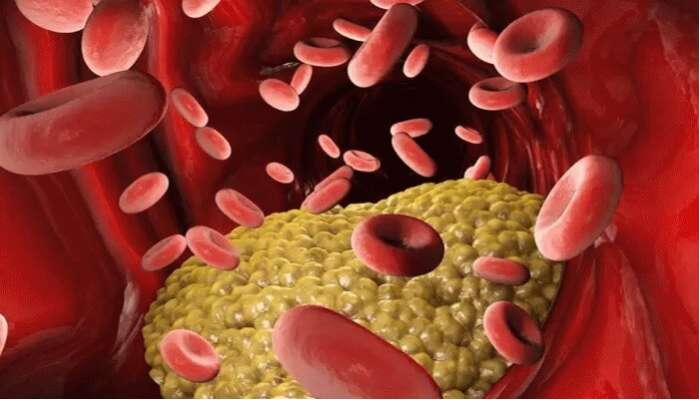 Cholesterol Tips: శరీరంలో కొలెస్ట్రాల్ పెరుగుతోందా, ఈ సంకేతాలుంటే తస్మాత్ జాగ్రత్త