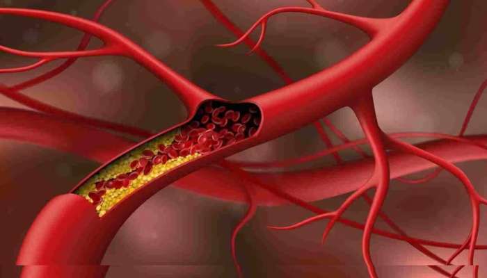 Cholesterol Tips: రక్త నాళాలపై దుష్ప్రభావం చూపే కొలెస్ట్రాల్, ఎలా తగ్గించుకోవాలి