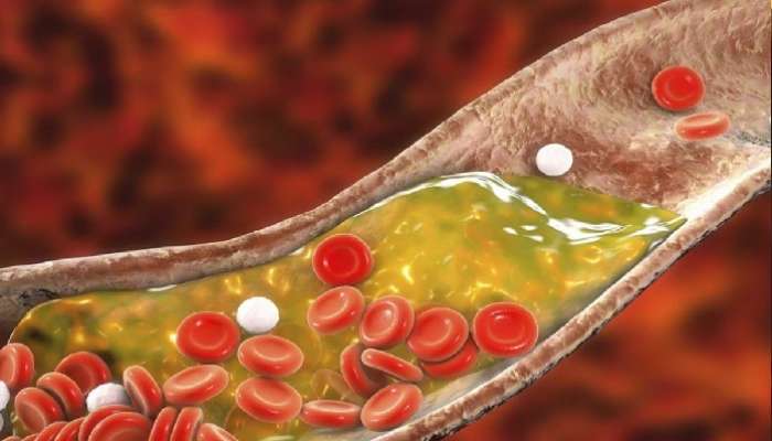 High Cholesterol Tips: శరీరంలో ఈ లక్షణాలుంటే కొలెస్ట్రాల్ పెరుగుతున్నట్టు అర్ధం, తస్మాత్ జాగ్రత్త