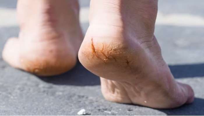 Cracked Heels: పాదాల్లో పగుళ్లు బాదిస్తున్నాయా, ఈ విటమిన్ల లోపం కావచ్చు