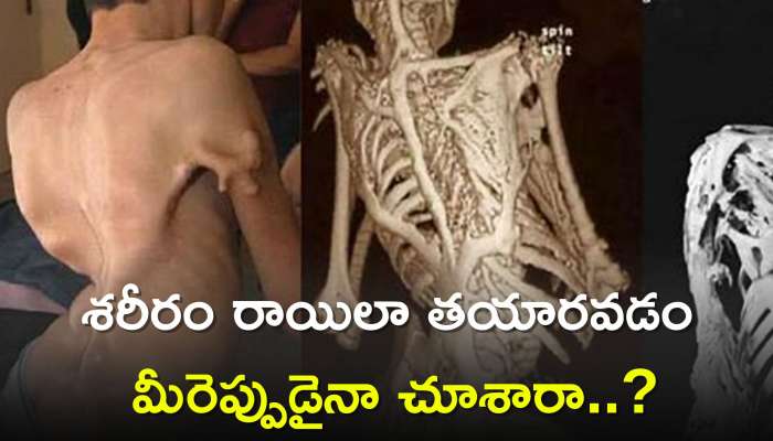 Rare Disease: అరుదైన వ్యాధిని కనుగొన్న వైద్యులు.. శరీరం రాయిలా తయారవడం మీరెప్పుడైనా చూశారా..?