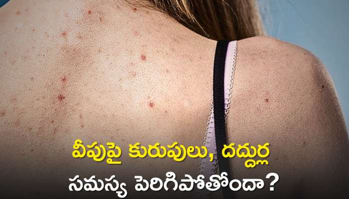 Home Remedies For Pimples: వీపుపై కురుపులు, దద్దుర్ల సమస్య పెరిగిపోతోందా?, ఎలాంటి ఖర్చు లేకుండా ఇలా 2 రోజుల్లో చెక్‌