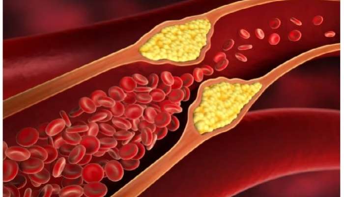 Cholesterol Types: కొలెస్ట్రాల్ అంటే ఏంటి, ఎన్ని రకాలు, ట్రై గ్లిసరాయిడ్స్, ఎల్‌డీఎల్, హెచ్‌డీఎల్ ఎంత ఉండాలి