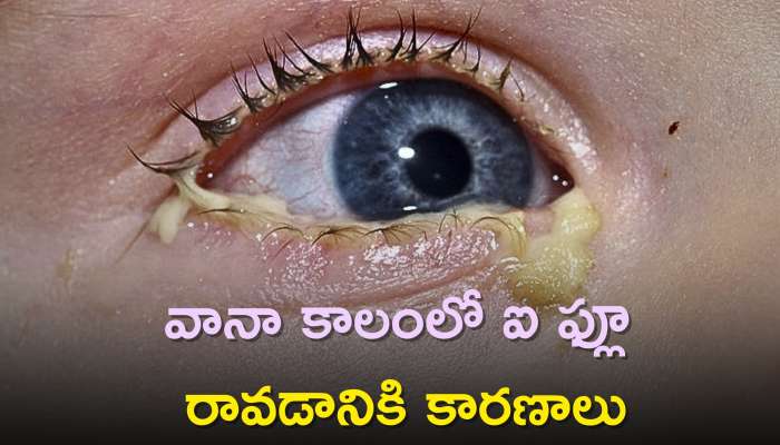  Eye Flu During Monsoon Season: వానా కాలంలో ఐ ఫ్లూ రావడానికి కారణాలు, లక్షణాలు, ఉపశమనం చిట్కాలు