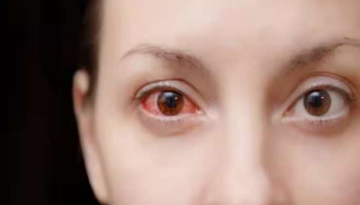 Eye Infections: కండ్ల కలక వస్తే ఎలాంటి జాగ్రత్తలు తీసుకోవాలి, ఏం చేయాలి, ఏం చేయకూడదు