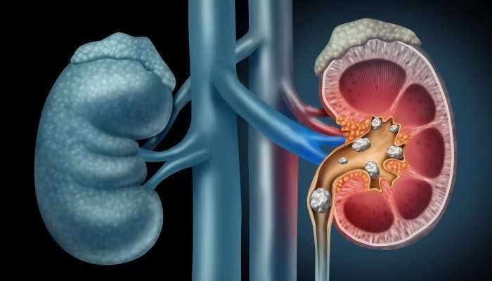 Kidney Stones: కిడ్నీలో రాళ్లు ఎందుకు ఏర్పడతాయి, ఎలా నియంంత్రించవచ్చు