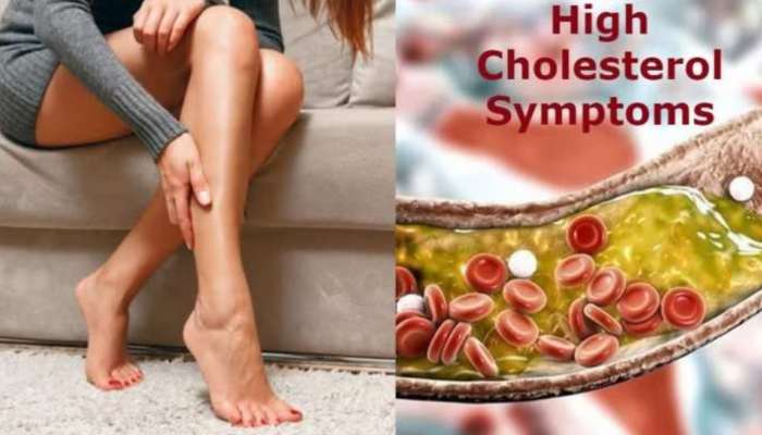 High Cholesterol: ఈ లక్షణాలు గమనించారా..? అయితే అధిక కొలెస్ట్రాల్ అని అర్థం!