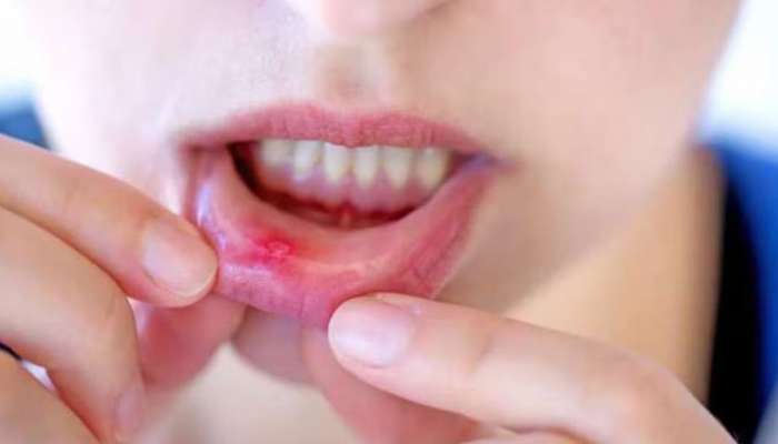 Mouth Ulcers: చిటికెలో మౌత్ అల్సర్ సమస్యను తగ్గించే ఇంటి చిట్కాలు