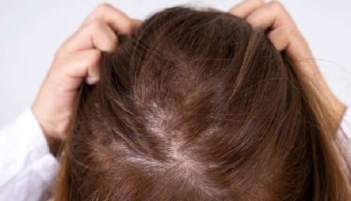 Hair Fall Problem: మధుమేహం పెరిగితే జుట్టు ఎందుకు రాలుతుంది, ఎలా చెక్ పెట్టాలి
