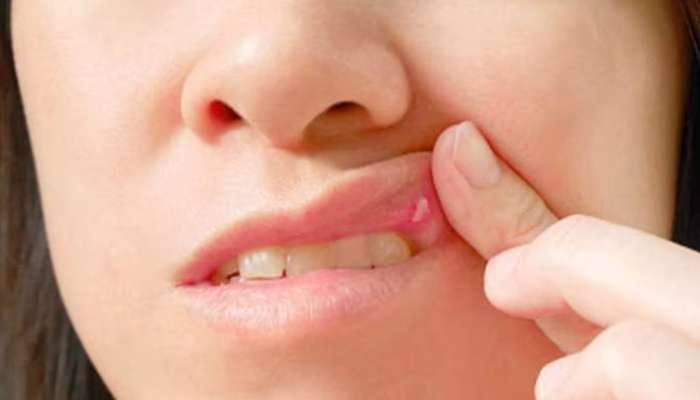 Mouth Ulcers: ఇట్టే నోటిపూతను తగ్గించే ఇంటి చిట్కాలు.. 
