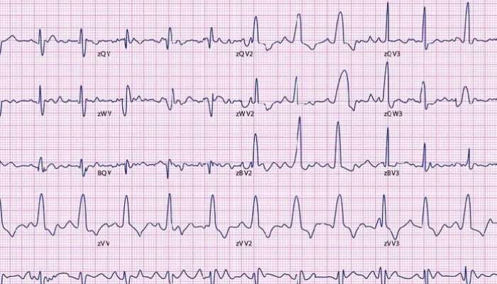 Irregular Heartbeat: హార్ట్ బీట్ అసాధారణంగా ఉందా, గుండెపోటు ముప్పు నుంచి ఎలా విముక్తి పొందాలి