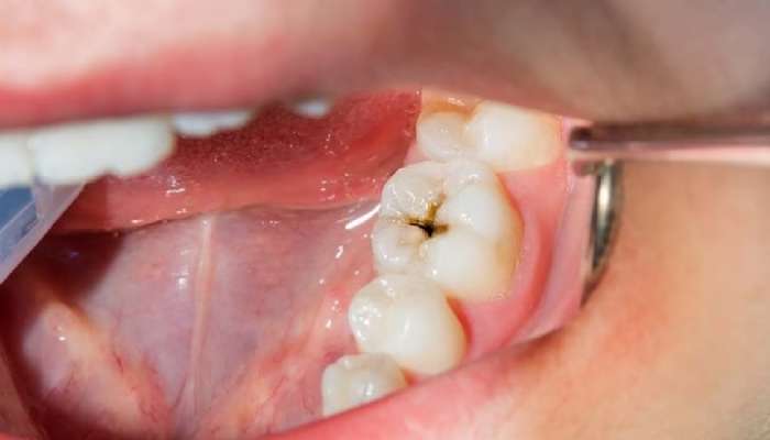 Teeth Cavity: కేవిటీ సమస్యను నిర్లక్ష్యం చేస్తే పళ్లు మొత్తం పుచ్చిపోగలవు, ఈ జాగ్రత్తలు తీసుకోండి