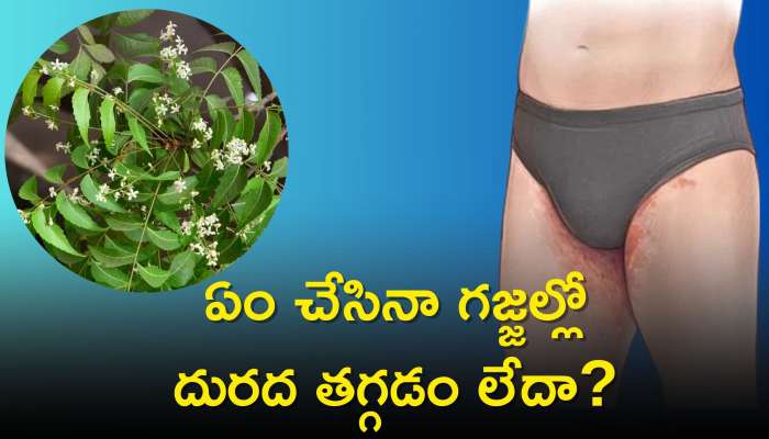 Cure Jock Itch: ఏం చేసినా గ‌జ్జ‌ల్లో దురద తగ్గడం లేదా? ఈ చిట్కాలతో శాశ్వతంగా చెక్ పెట్టొచ్చు..