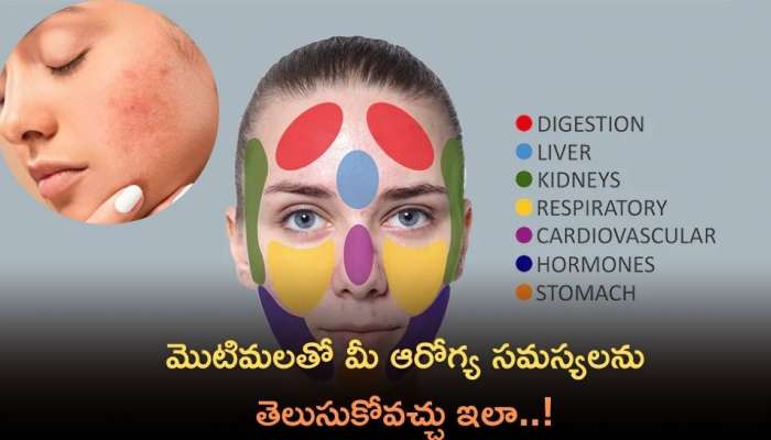 Pimples On Face: మొటిమలతో మీ ఆరోగ్య సమస్యలను తెలుసుకోవచ్చు ఇలా..!