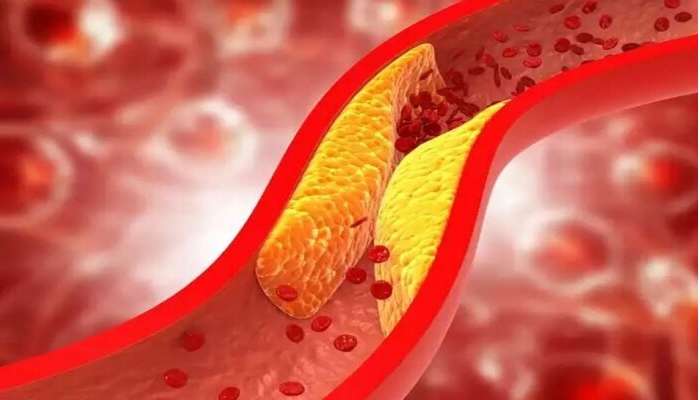 Cholesterol Tips: రోజూ క్రమం తప్పకుండా ఇలా మజ్జిగ చేసుకుని తాగితే కొలెస్ట్రాల్ ఇట్టే మాయం