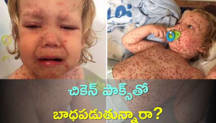 Chicken Pox: చికెన్ పాక్స్‌తో బాధపడుతున్నారా? కేవలం ఈ ఆహారాలనే తినాలి..ఎందుకంటే..