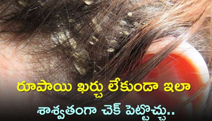 Dandruff Home Remedies: ఏం చేసినా చుండ్రు తగ్గట్లేదు.. రూపాయి ఖర్చు లేకుండా ఇలా శాశ్వతంగా చెక్ పెట్టొచ్చు..