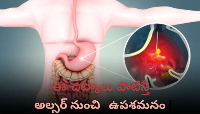 Gastric Ulcer: అల్సర్ కారణాలు.. ఈ చిట్కాలతో చికిత్స పొందండి ఇలా! 