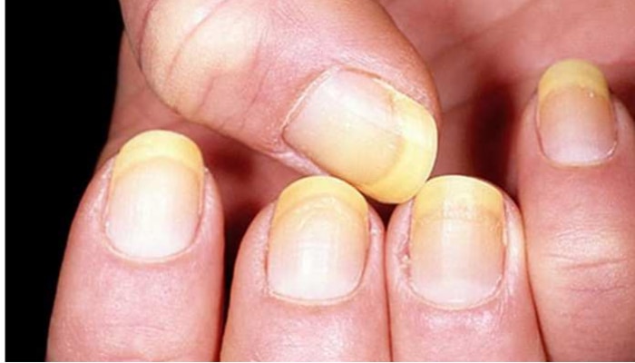 Nail Care Tips: గోర్లలో ఎన్నిరకాల బ్యాక్టీరియా, ఫంగస్ ఉంటాయో తెలిస్తే..ఇంకెప్పుడూ గోర్లు పెంచరు