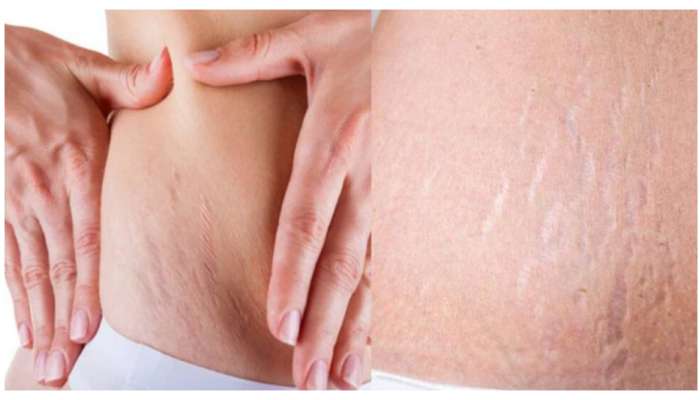 Get Rid of Stretch Marks: స్ట్రెచ్ మార్క్స్ తగ్గించడానికి అద్భుతమైన టిప్స్.. కొన్నిరోజుల్లోనే చర్మం మచ్చలేకుండా కనిపిస్తుంది..