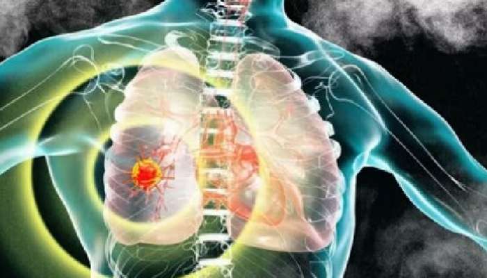 Lung Cancer Vaccine: ఆక్స్‌ఫర్డ్ మరో ఘనత , ప్రపంచంలోనే తొలిసారిగా లంగ్ కేన్సర్‌కు వ్యాక్సిన్