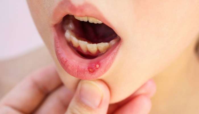 Mouth Ulcers: నోటి అల్సర్లు.. ఈ ఆహారపదార్థాలకు దూరంగా ఉండాలి !