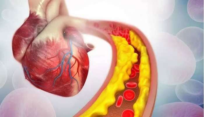 Cholesterol Diseases: శరీరంలో కొలెస్ట్రాల్ ఉంటే ఈ 4 ప్రాణాంతక వ్యాధులున్నట్టే