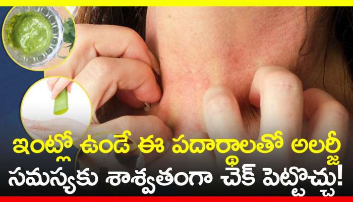 Allergy Home Remedies: ఇంట్లో ఉండే ఈ పదార్థాలతో అలర్జీ సమస్యకు శాశ్వతంగా చెక్‌ పెట్టొచ్చు!