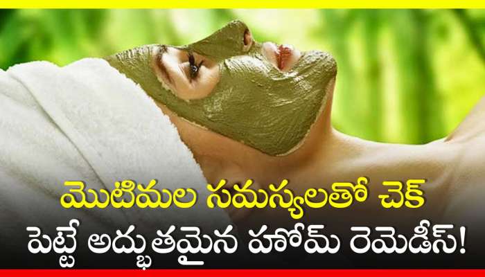 Home Remedies For Acne: మొటిమల సమస్యలతో చెక్‌ పెట్టే అద్భుతమైన హోమ్‌ రెమెడీస్‌!