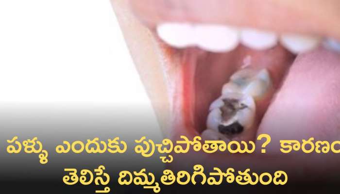 Reasons For Tooth Decay: పళ్ళు ఎందుకు పుచ్చిపోతాయి? కారణం తెలిస్తే దిమ్మతిరిగిపోతుంది!