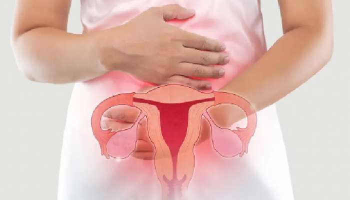 Ovarian Cancer: ఒవేరియన్ కేన్సర్ గురించి ప్రచారంలో ఉన్న 6 అబద్ధాలు, వాస్తవాలు