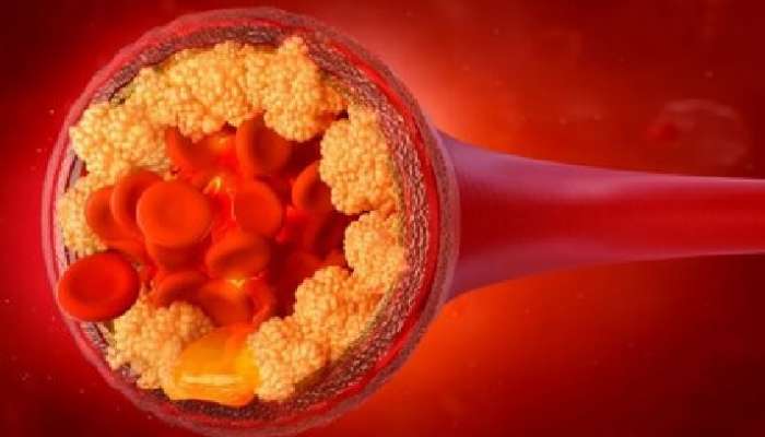 Cholesterol Control Tips: కొలెస్ట్రాల్‌ను సమూలంగా నిర్మూలించే అద్భుతమైన జ్యూస్