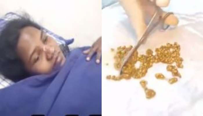 Stones in woman stomach: షాకింగ్ లో డాక్టర్లు.. మహిళ కడుపులో 570 రాళ్లు.. అసలేం జరిగిందంటే..?