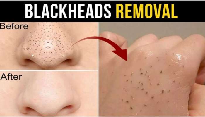 Blackheads: ముక్కుపై బ్లాక్ హెడ్స్ ఒక్క రోజులో మాయం అవ్వాలంటే…ఈ బెస్ట్ టిప్స్ మీకోసం!