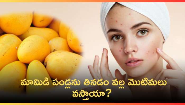 Mango Cause Acne: మామిడి పండ్లను తినడం వల్ల మొటిమలు వస్తాయా? 