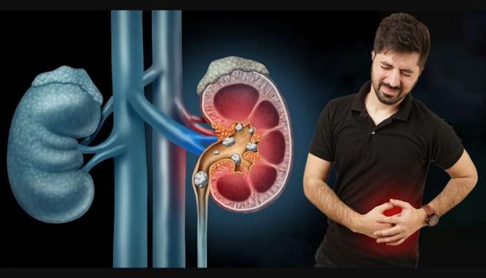 Kidney Stones: ఒక్క గ్లాస్ జ్యూస్.. కిడ్నీలో రాళ్లన్నీ మటుమాయం..