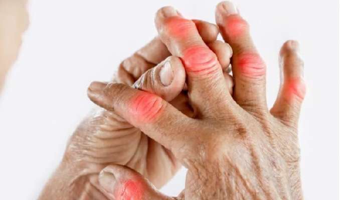 Arthritis Precautions: ఆర్ధరైటిస్ తో బాధపడుతున్నారా, వెంటనే ఈ 5 పుడ్స్ మానేయండి