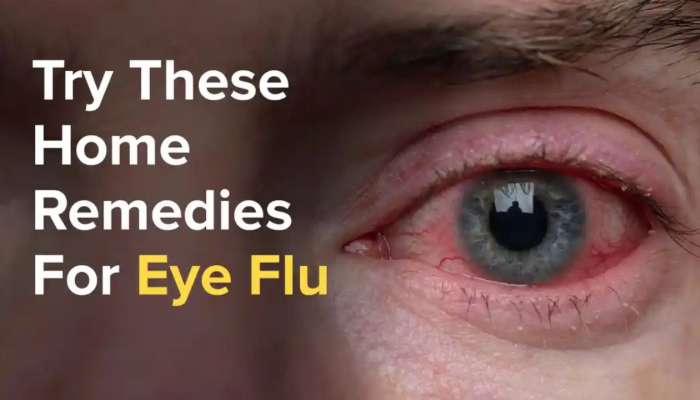 Remedies ForEye Flu: ఐ ఫ్లూ సమస్యతో బాధపడుతున్నారా..అయితే చిట్కాలు మీకోసం!