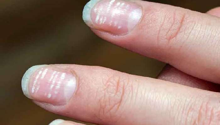 White Spots on Nails: మీ గోర్లపై ఈ తెలుపు మచ్చలున్నాయా, అయితే ఈ వ్యాధుల ముప్పు ఉన్నట్టే