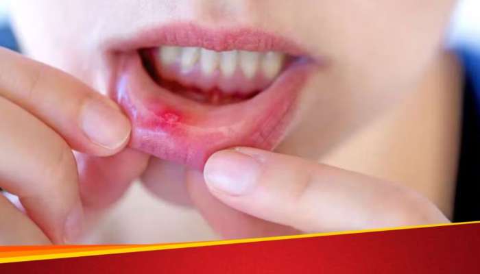 Mouth Ulcer: మౌత్ అల్సర్ క్షణంలో ఉపశమనం పొందడం ఎలా?