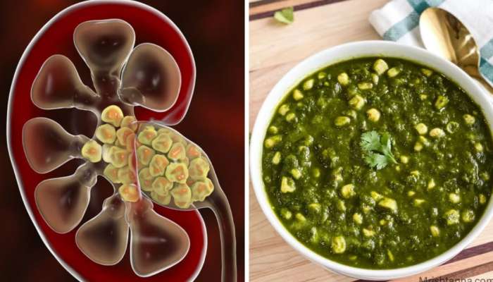 Kidney Stones: కిడ్నీలు ఆరోగ్యంగా ఉండాలంటే వీటిని ప్రతిరోజు తీసుకోవాల్సిందే..!