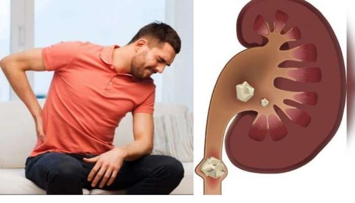 Kidney Stones: కిడ్నీలో రాళ్లు ఎలా ఏర్పడతాయి, ఎలా తొలగించుకోవచ్చు