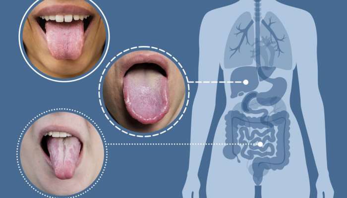 Unhealthy Tongue Colour: నాలుక రంగు బట్టి మీ వ్యాధి గురించి తెలుసుకోవచ్చు..!