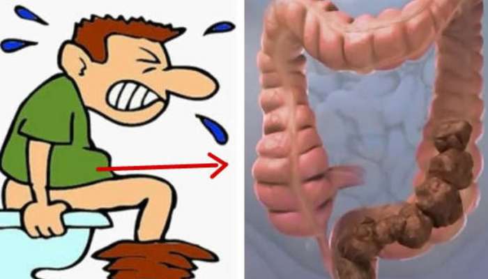 Constipation: మలబద్ధకం సమస్య శాశ్వతంగా ఉపశమనం పొందండి ఇలా..!