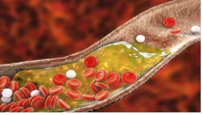 Cholesterol Night Signs: రాత్రి వేళ ఈ 5 లక్షణాలు కన్పిస్తే కొలెస్ట్రాల్ తీవ్రంగా ఉన్నట్టే